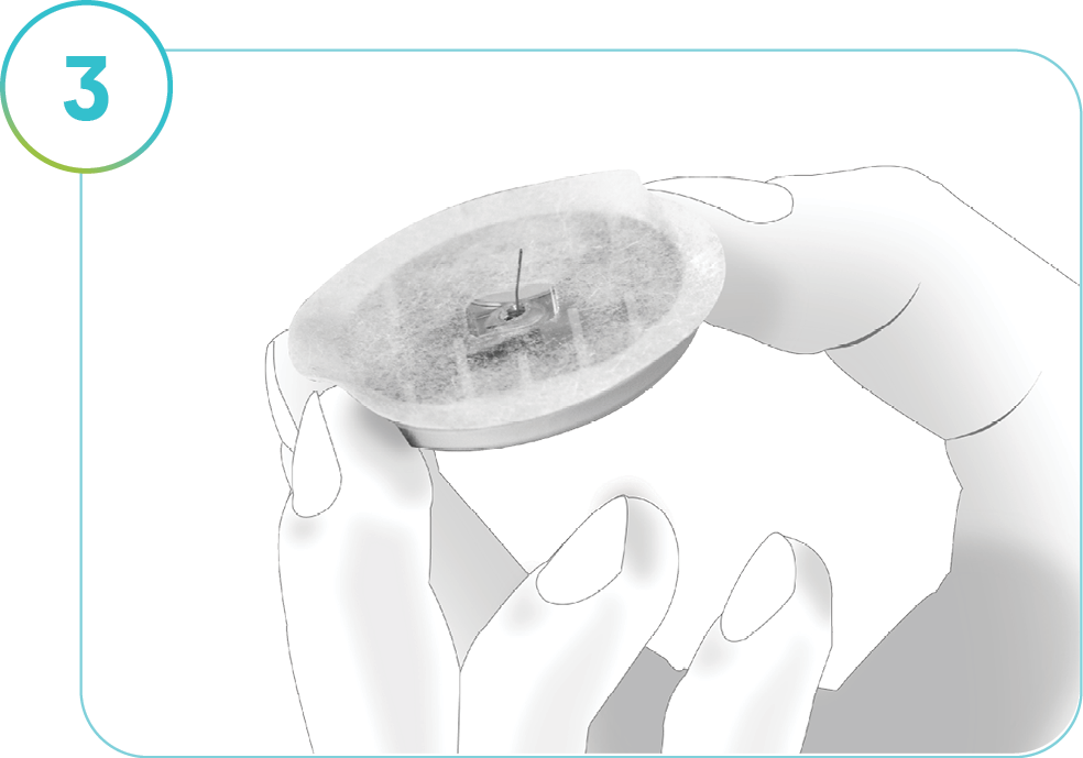 Image showing the SmartGuide CGM removed from the skin.